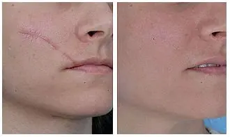 علاج الندبات